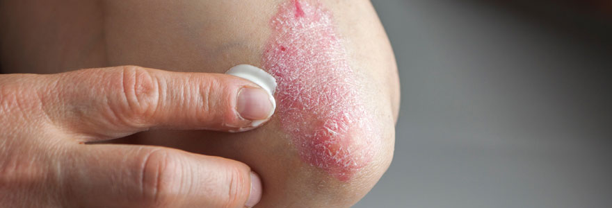 Eczéma et le psoriasis