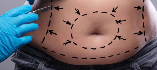 chirurgie esthetique