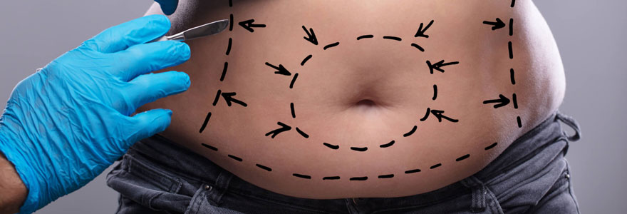 chirurgie esthetique